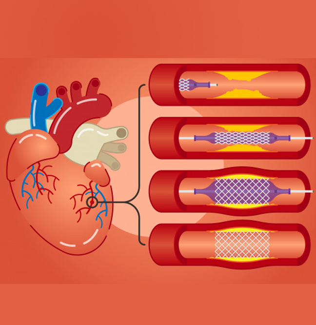angioplastia coronaria