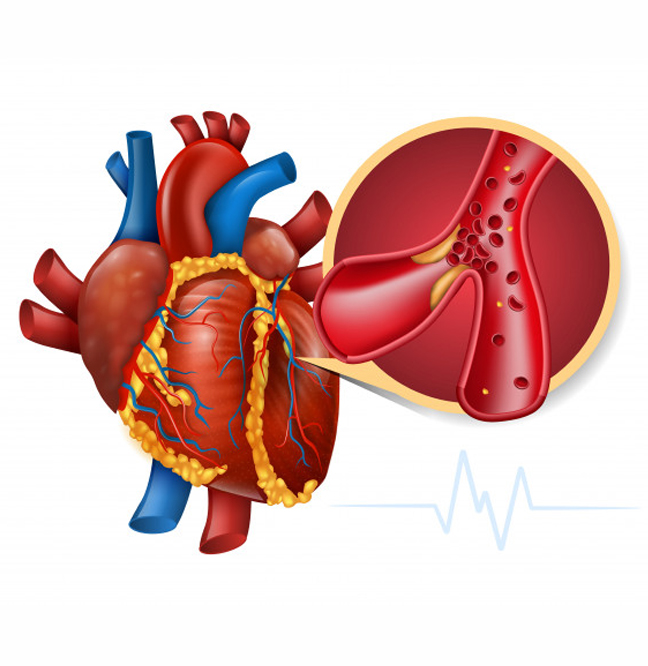 Intervención Aorta