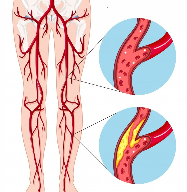 Arterial Periférica